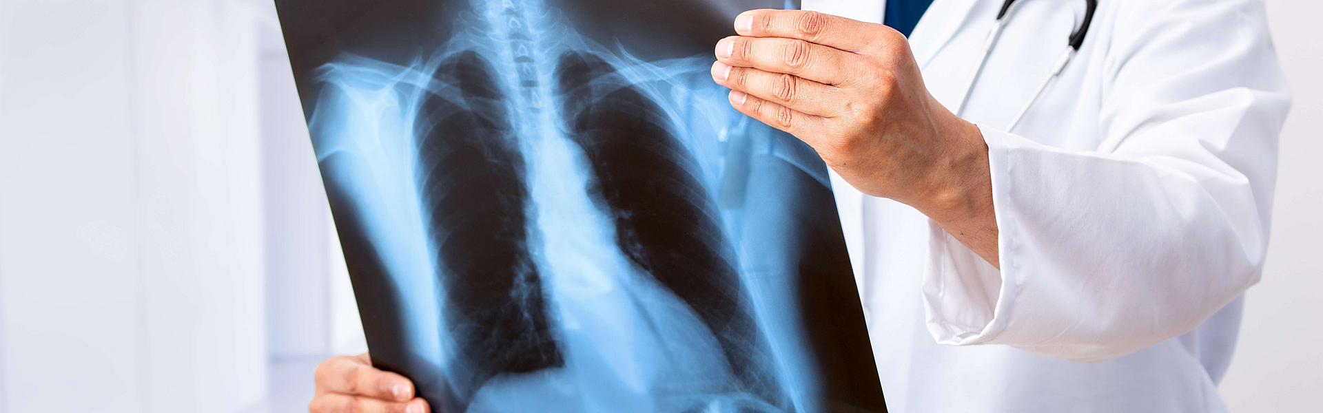 Lungenkrebs oder Lungenentzündung. Arzt-Check-up-Röntgenbild haben Problem Lungentumor des Patienten oder lange covid 19.