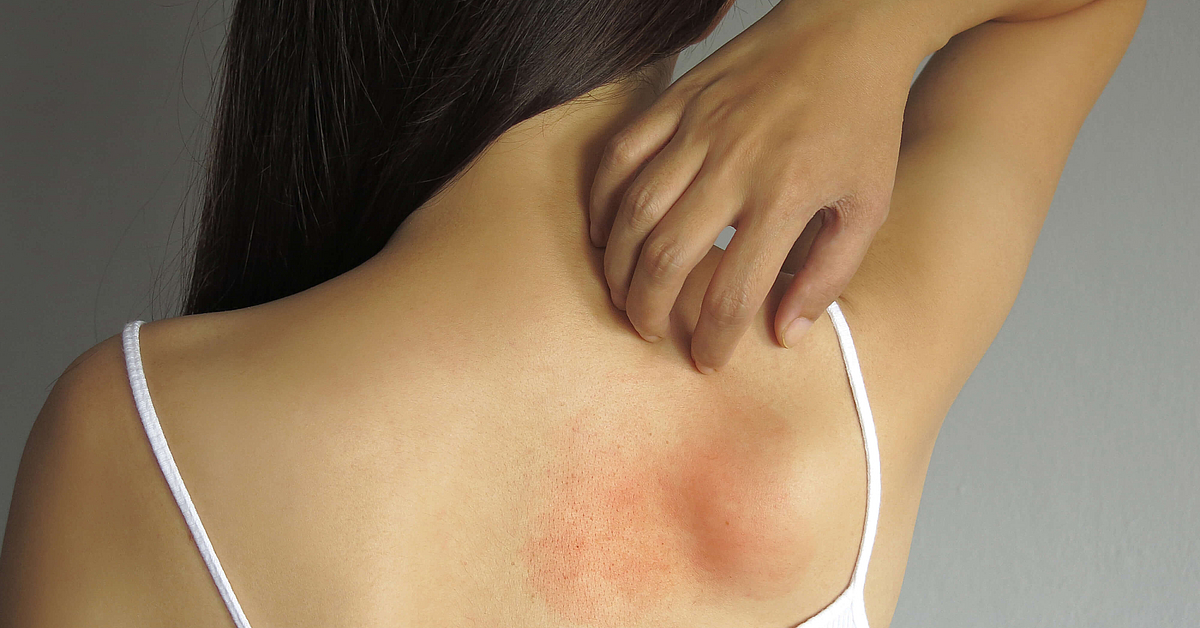Hautausschlag durch Stress: Grnde & Hilfe | mhplus Krankenkasse Hautausschlag durch Stress: Grnde & Hilfe | mhplus Krankenkasse