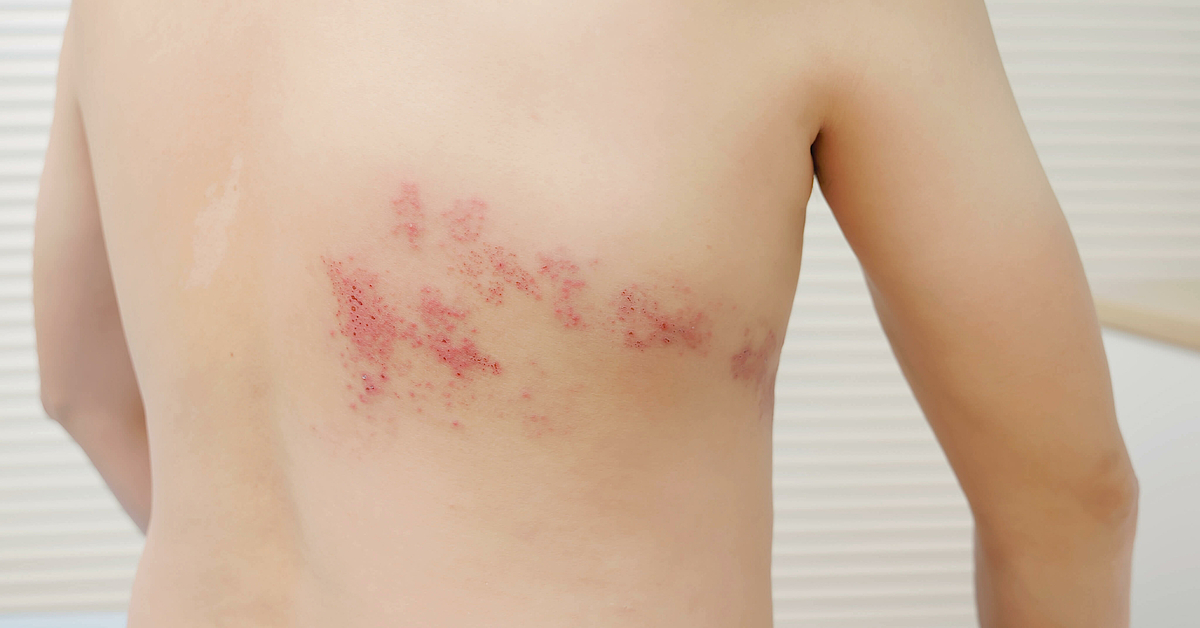 Was ist eigentlich Gürtelrose? mhplus Krankenkasse