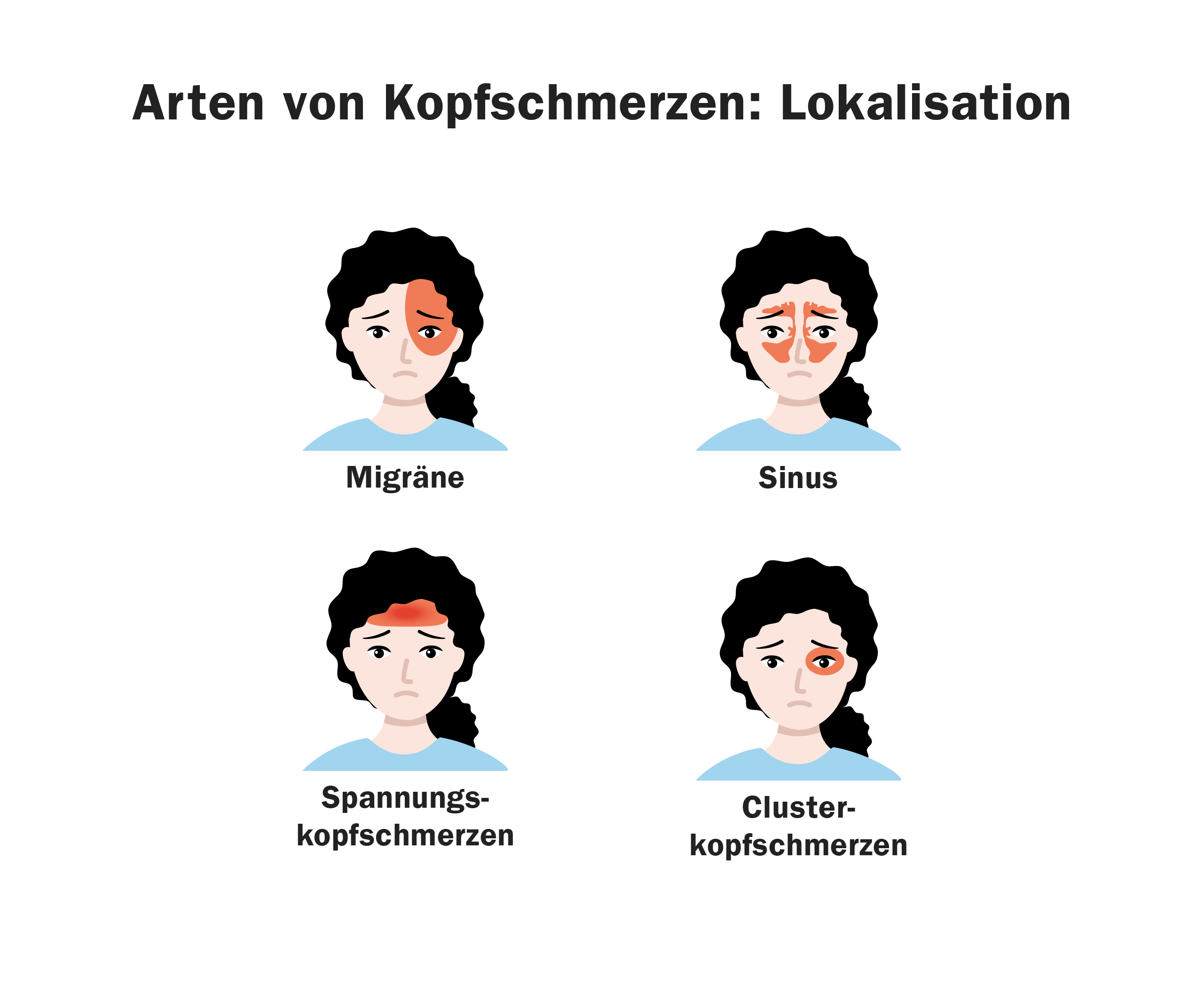 Grafik mit vier Gesichtern, es sind jeweils die Regionen im Gesicht markiert, die mit einer bestimmten Art von Kopfschmerzen in Verbindung stehen: Migräne - einseitig auf Höhe der Augen, Sinuskopfschmerz - rund um die Nase also Bereich der Stirn, Augen und Wangen, Spannungskopfschmerzen - beidseitig Stirn/Hinterkopf, Clusterkopfschmerzen - einseitig hinter einem Auge oder Schläfe 